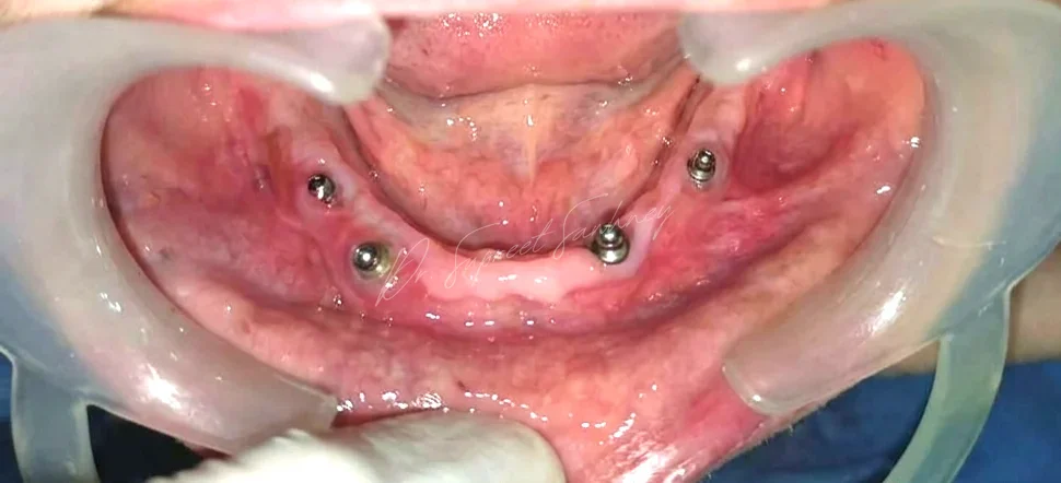 Edentulous mandibular arch showing four implant abutments